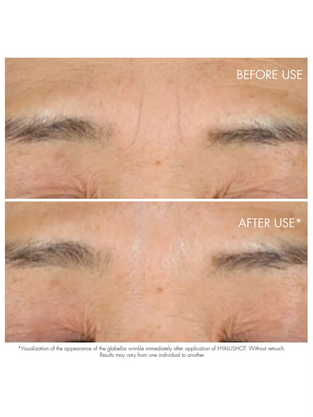 Capture Totale Hyalushot 15ml