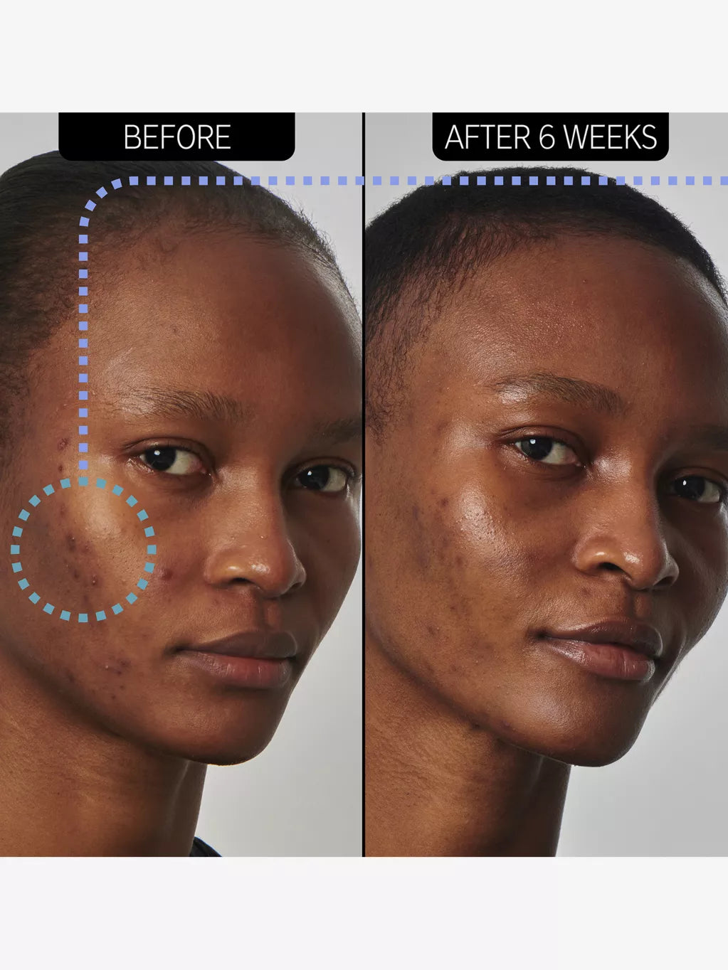 SuperSolutions 20% niacinamide serum 30ml